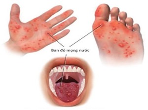 Trạm Y tế phường Chương Mỹ tuyên truyền bệnh tay- chân - miệng nguyên nhân và cách phòng tránh cho trẻ.